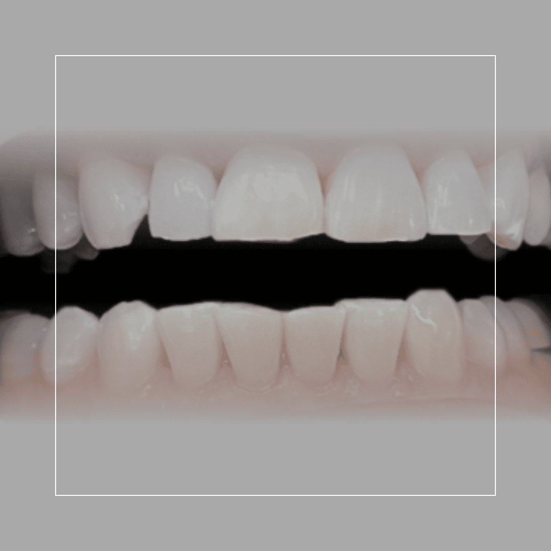 Zoom! 2 Tooth Whitening – Yellow Shades